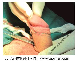 手术后钛钉缝合线与术前定位切割线接近吻合