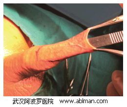 检查尿道口平面与包皮切割线的相对位置