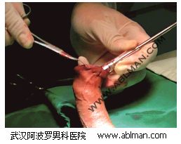 包皮环切手术中，环扎固定丝线断裂