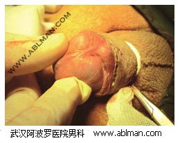 切割手术完成后检查系带侧包皮钛钉缝合情况