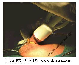 阴茎与环切缝合器间相对无张力的情况下夹闭两手柄行包皮切割缝合