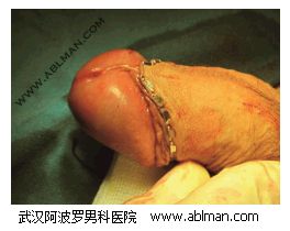 手术后观察包皮系带处的切割情况（长度适中、表面光滑）