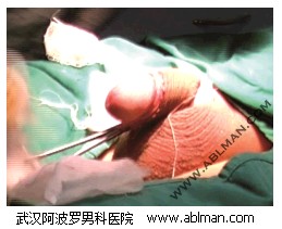 包皮切割手术完毕后检查钛钉缝合情况